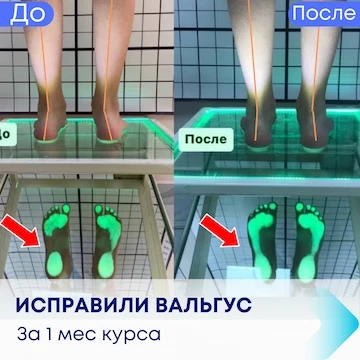 Результати виправлення вальгусу