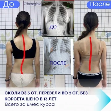 Результати лікування сколіозу 3 ст.