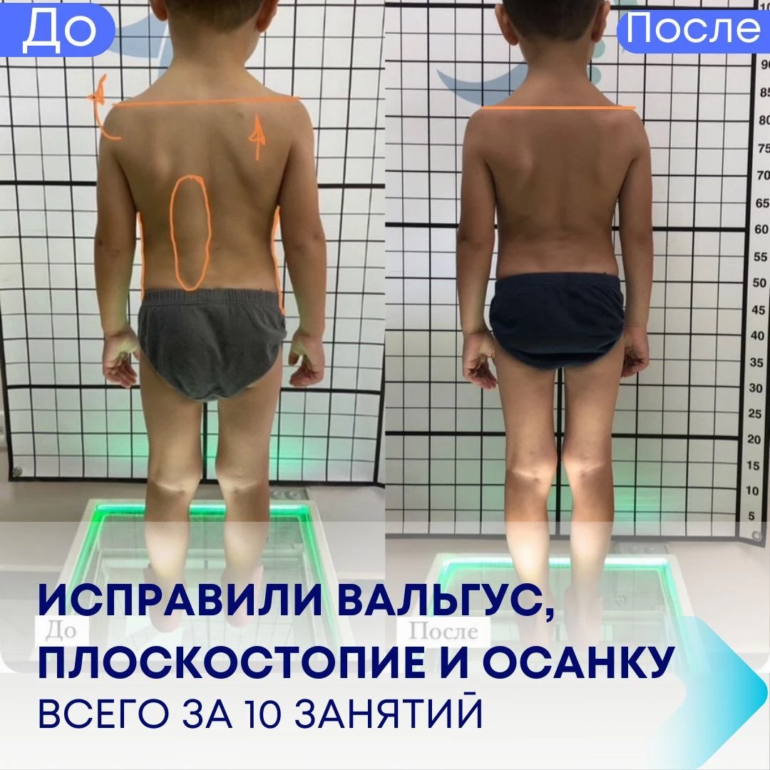 Результати виправлення вальгусу, плоскостопості та постави