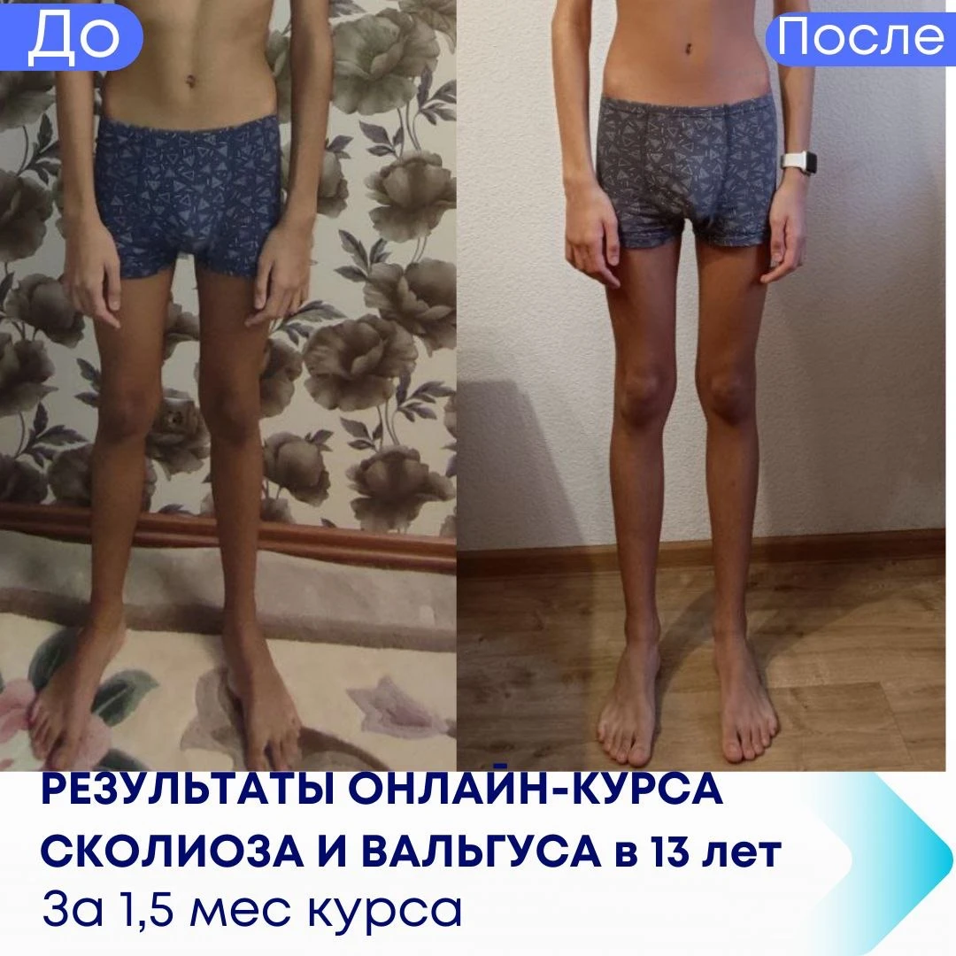 Результати лікування сколіозу та вальгусу