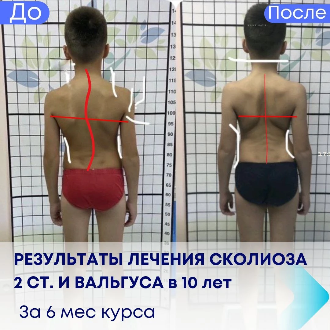 Результати лікування сколіозу 2 ст. та вальгусу